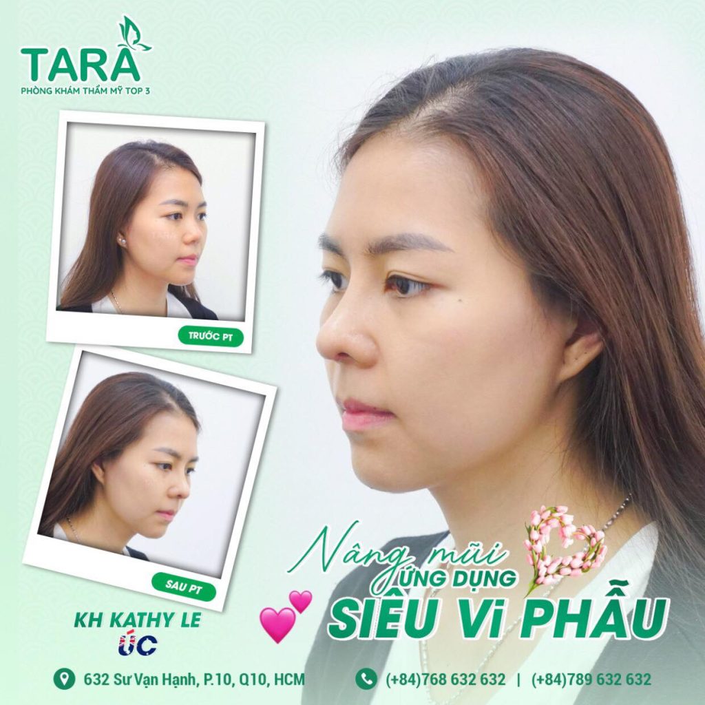 TS.BS Trang: Nâng mũi bóc tách siêu vi phẫu không cần nẹp, 3 ngày vào form
