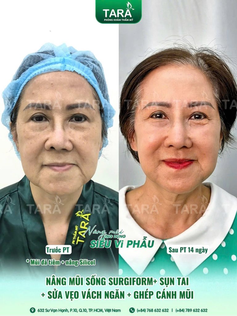 Từ A-Z: Nâng mũi siêu vi phẫu cho người lớn tuổi