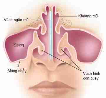 Từ A-Z về nâng mũi sụn vách ngăn