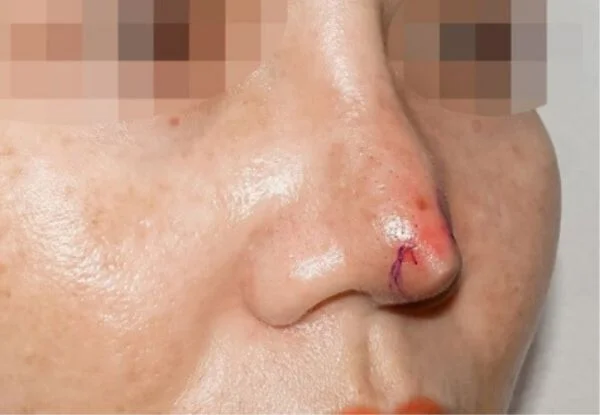 Nhận biết tình trạng tụt sụn mũi sau nâng và giải pháp