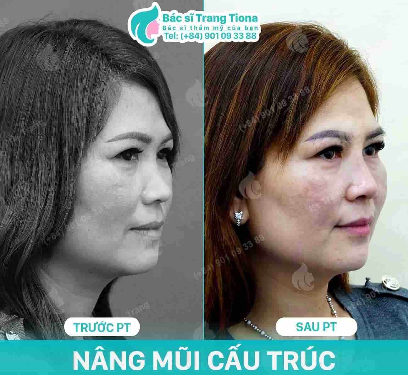 U50 có nên nâng mũi không? Mũi có đẹp không?