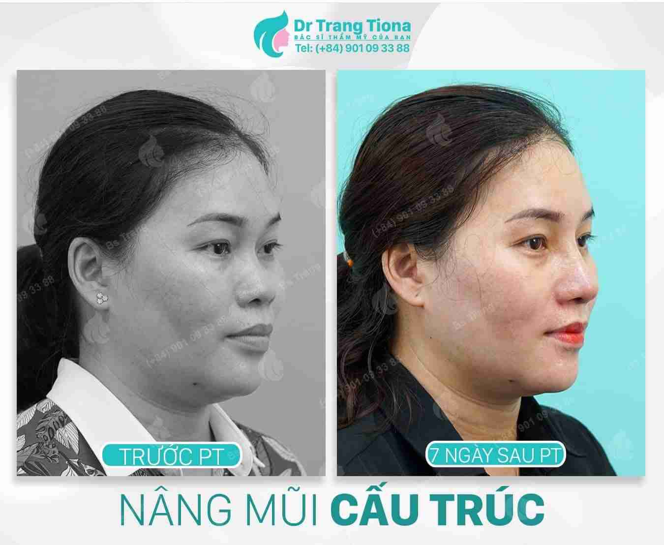 U50 có nên nâng mũi không? Mũi có đẹp không?