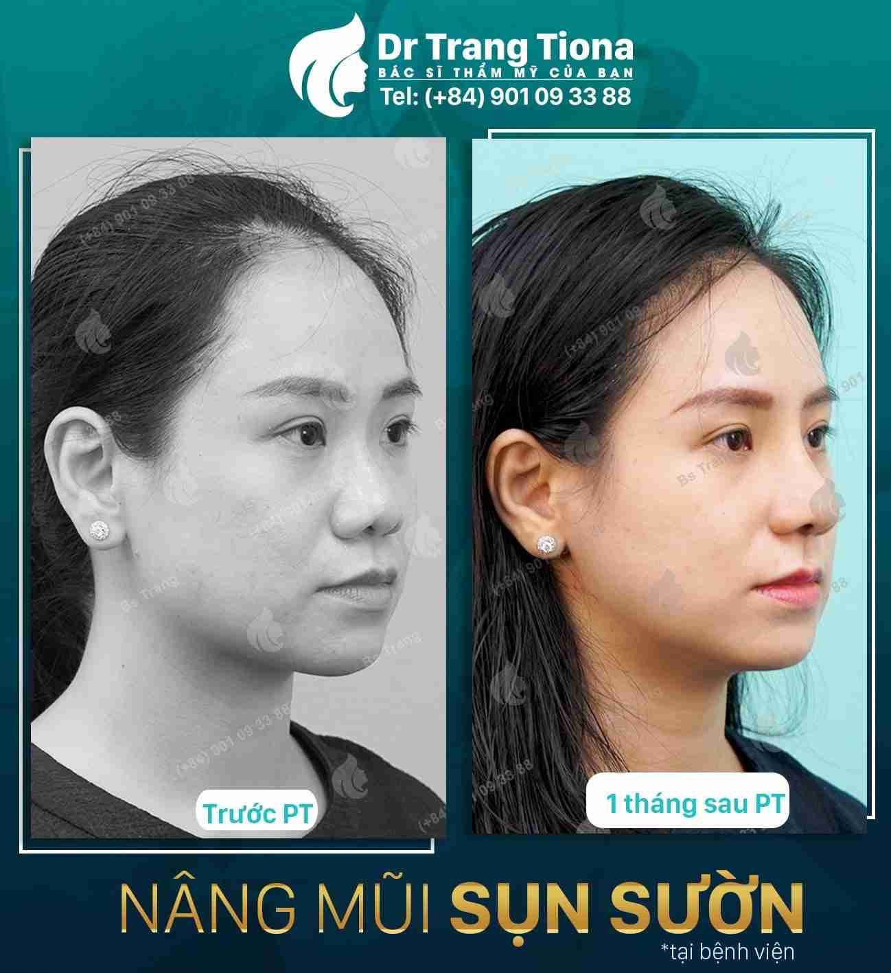 Điểm danh 6 ưu và nhược điểm của nâng mũi sụn sườn