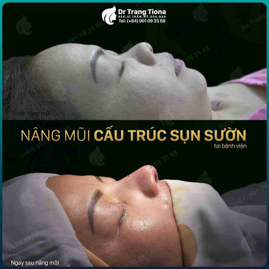 Điểm danh 6 ưu và nhược điểm của nâng mũi sụn sườn