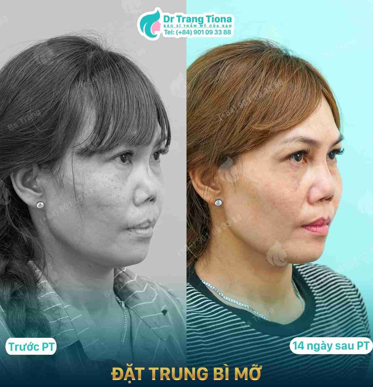 6 ưu và nhược điểm của nâng mũi trung bì mỡ