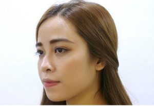Xem tướng mũi gãy và lỗ mũi bên to bên nhỏ: Nguyên nhân và khắc phục triệt để bằng nâng mũi siêu vi phẫu