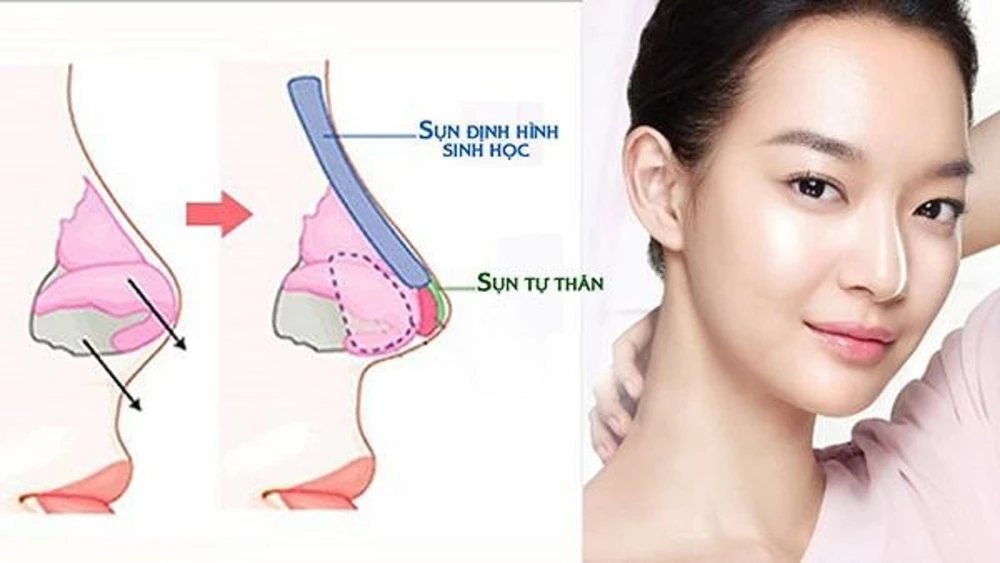 Xỏ khuyên mũi có nâng mũi được không? An toàn không?