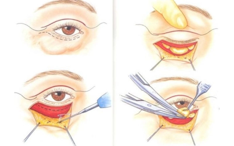 Xoá rãnh lệ hiệu quả từ phẫu thuật dàn đều mỡ dưới mắt